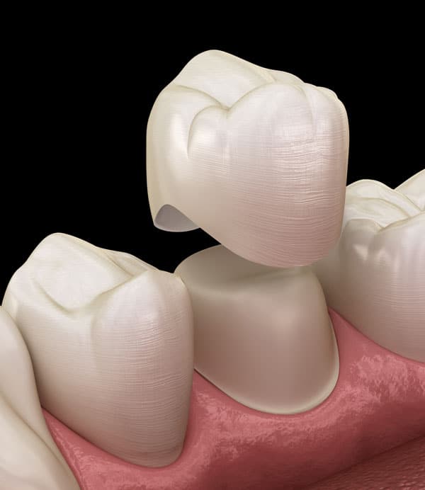 Crowns in phoenix dentist