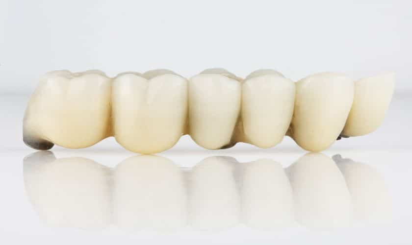 Dental Bridges for Missing Teeth