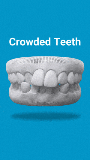 Dental model displaying crowded teeth condition against blue background for Highland Dental Studio Phoenix educational purposes.