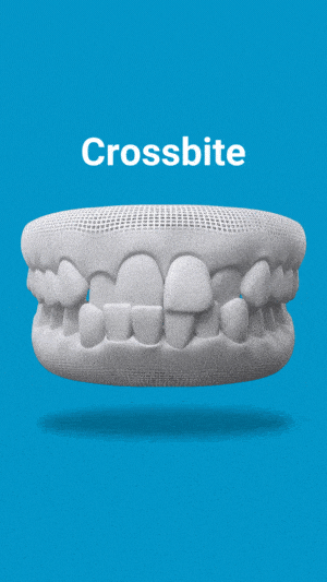 Crossbite dental model showing misaligned upper and lower teeth on blue background.