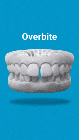 Dental model showing overbite malocclusion on blue background with label