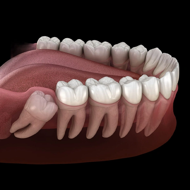 3D dental illustration comparing natural teeth structure with prosthetic implants and gum anatomy.