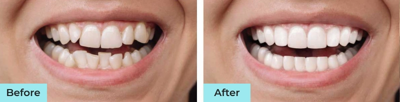 Before and after comparison of teeth whitening results showing brightened smile transformation at Highland Dental Studio Phoenix.