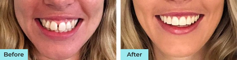 Before and after comparison of smiling patients showing dental improvement results from Highland Dental Studio Phoenix.