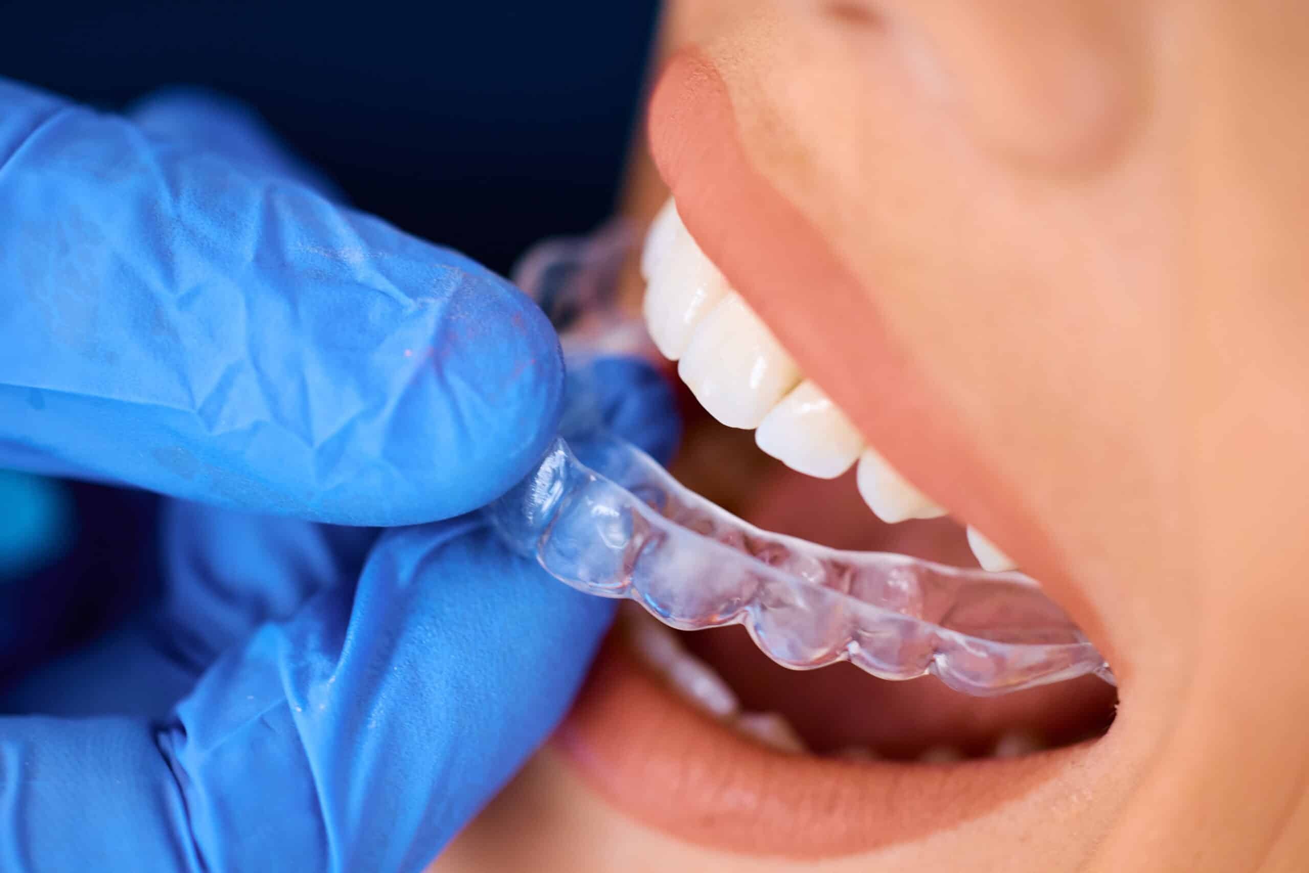 Dentist placing clear aligner tray on patient's lower teeth during Invisalign treatment.