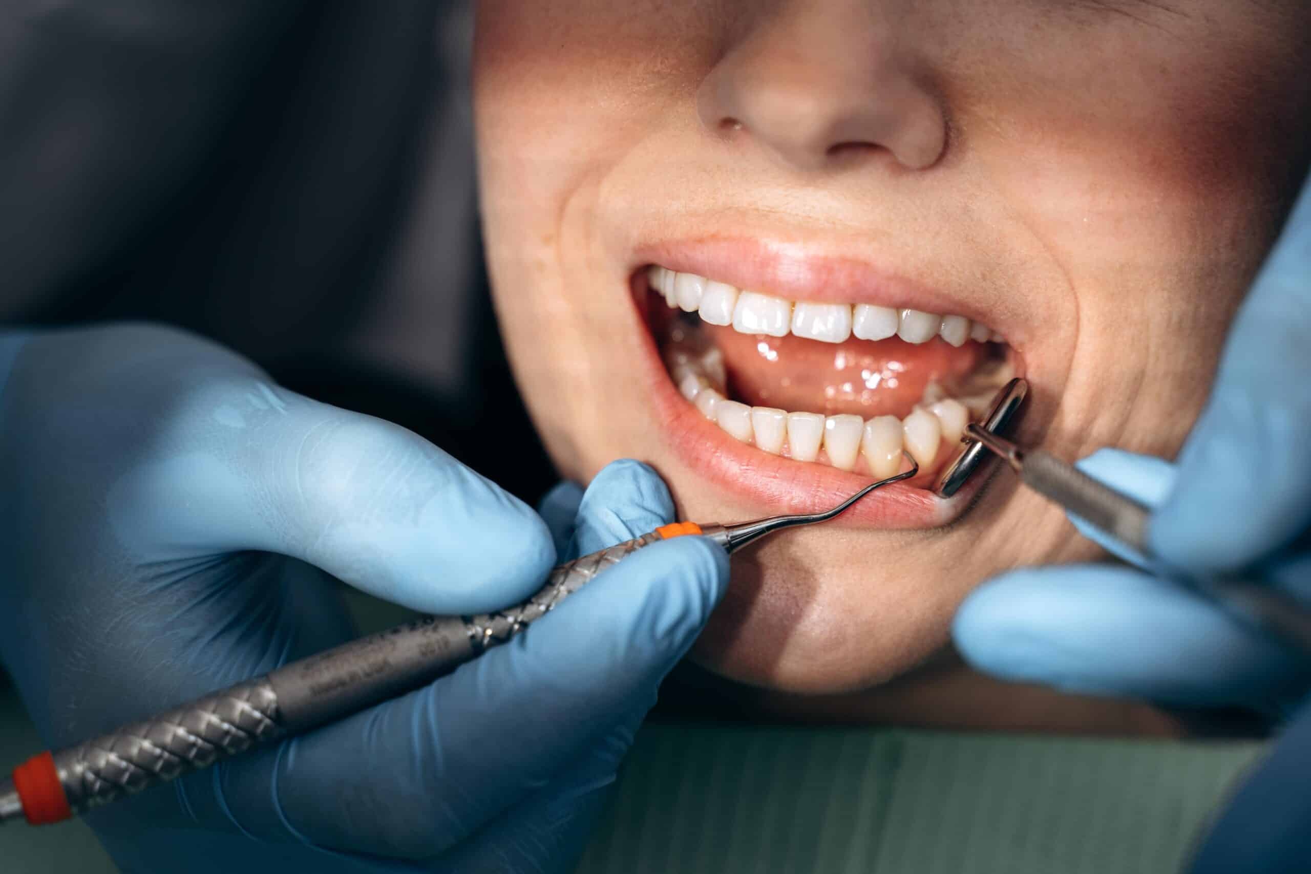 Dentist examining patient's teeth with ultrasonic scaler during dental cleaning procedure.