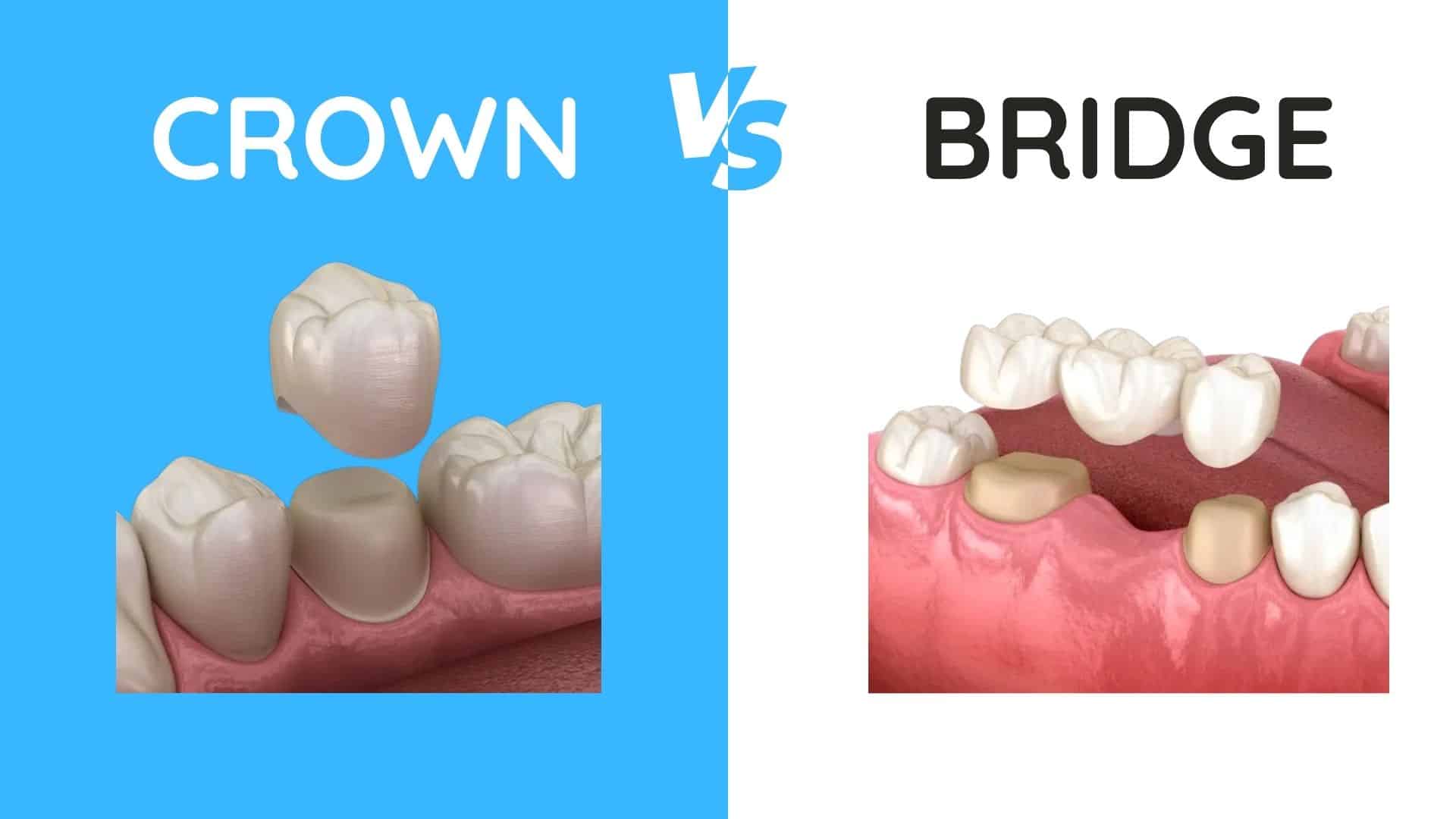 Featured image for “Dental Crown vs Bridge: Explain the Differences”
